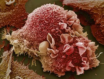 Tìm hiểu cách thức tế bào gốc khỏe mạnh tiến triển thành tế bào ung thư trên mô hình bệnh ung thư khoang miệng dương tính HPV