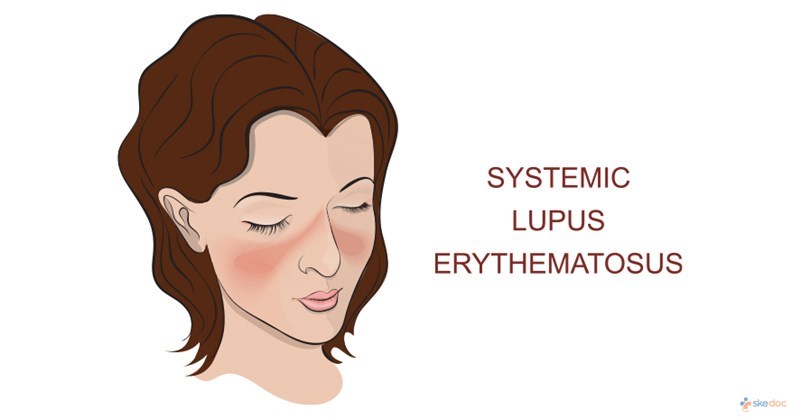 Tế bào gốc trung mô (MSC) trong điều trị Lupus ban đỏ hệ thống: nghiên cứu mới xác định dấu ấn sinh học tiềm năng để dự báo hiệu quả điều trị