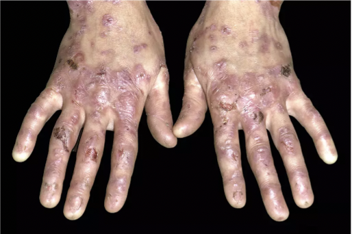 Liệu pháp tế bào gốc trung mô CORDStrom với bệnh ly thượng bì bóng nước thể loạn dưỡng lặn (RDEB) và kế hoạch đăng ký cấp phép sản phẩm với FDA Hoa Kỳ