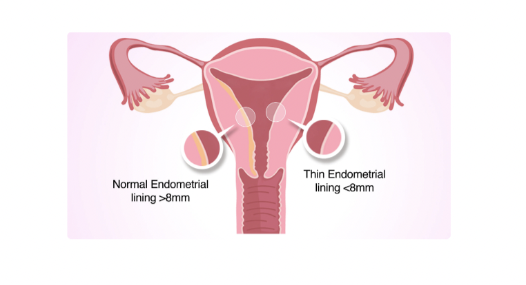 Tăng cường tái tạo niêm mạc tử cung: tiềm năng điều trị của tế bào gốc trung mô dây rốn và dịch ly giải tiểu cầu siêu hoạt hóa