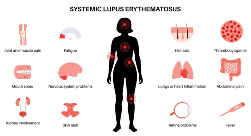 Triển vọng điều trị bệnh lupus ban đỏ hệ thống (SLE) bằng liệu pháp CAR-T đồng loại