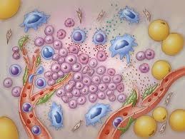 Vai trò của tương tác giữa đại thực bào liên quan đến khối u và nguyên bào sợi liên quan đến ung thư trong môi trường vi mô của sarcoma mô mềm