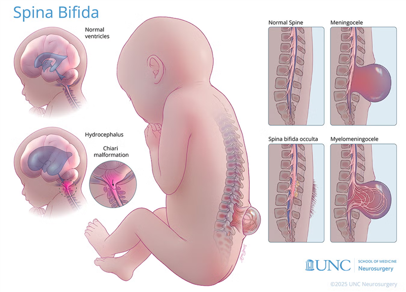 Liệu pháp tế bào gốc trung mô (MSC) an toàn và khả thi trong hỗ trợ điều trị tật nứt đốt sống ở thai nhi