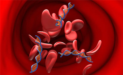 Chỉnh sửa vùng khởi động của gen HBG1 và HBG2 trên tế bào gốc tạo máu để điều trị bệnh thiếu máu hồng cầu hình liềm