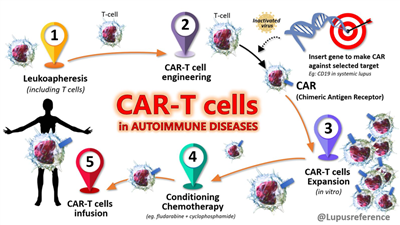 Liệu pháp CAR-T điều trị thành công đồng thời ba bệnh tự miễn trên cùng một bệnh nhân