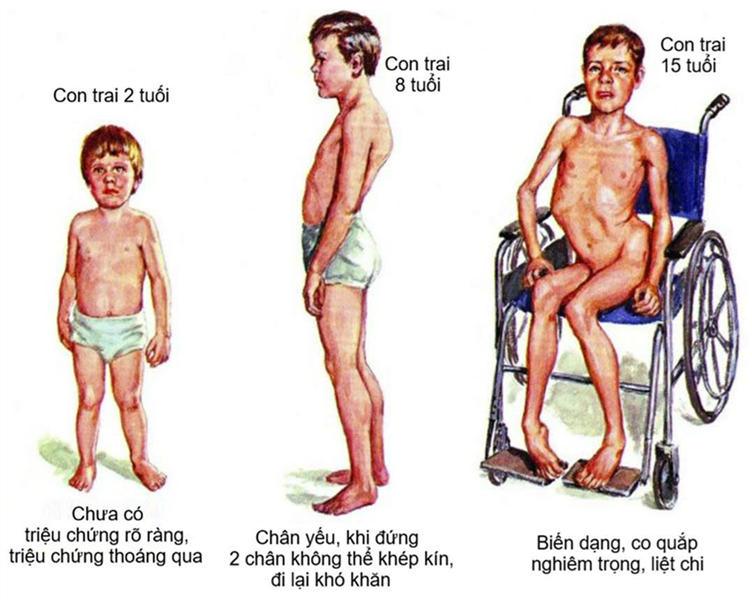Liệu pháp tế bào Deramiocel làm chậm tiến triển bệnh loạn dưỡng cơ Duchenne