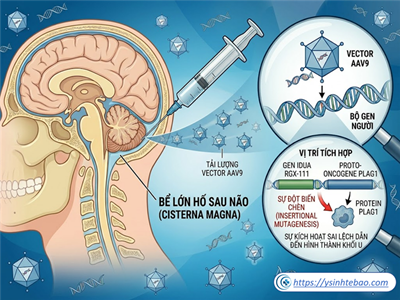 Ca lâm sàng hiếm gặp về vector chuyển gen trực tiếp gây nên u não ở bệnh nhân: Sự cân bằng giữa lợi ích và tính an toàn khi ứng dụng liệu pháp gen