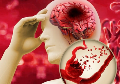 Kỷ nguyên mới trong điều trị đột quỵ: Liệu pháp Exosomes và các chiến lược tối ưu hóa hiệu quả phục hồi não